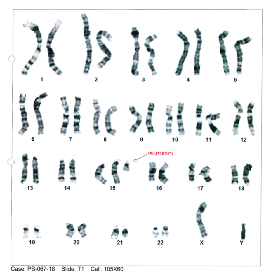 Unbalanced derivative chromosome 15 article image