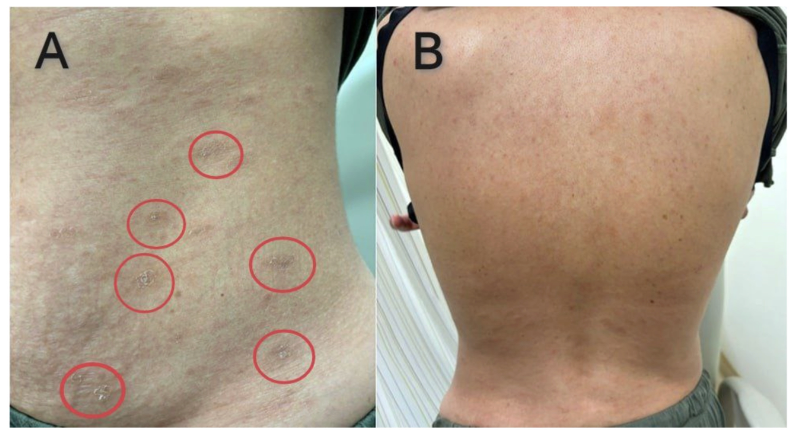 Pityriasis rosea article image