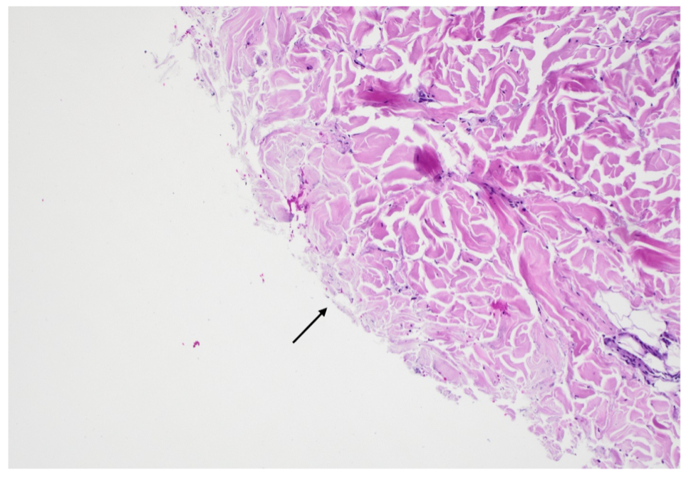 Toxic Epidermal Necrolysis article image